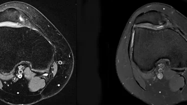 Scanningsbillede af et knæ.