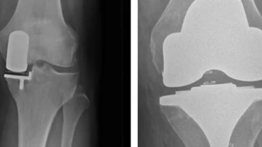 Røntgenbillede af knæprotese.