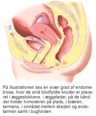 Svær grad af endometriose.