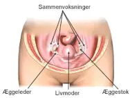 Sammenvoksninger af æggeleder og æggestok.