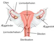 Sterilisation af livmoderen.