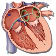 Illustration af RFA ablation.