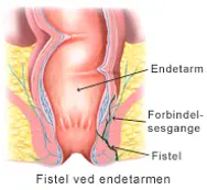 Fistel ved endetarmen.