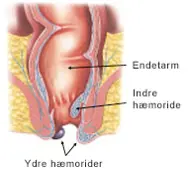 Ydre og inde hæmoride ved endetarmen.