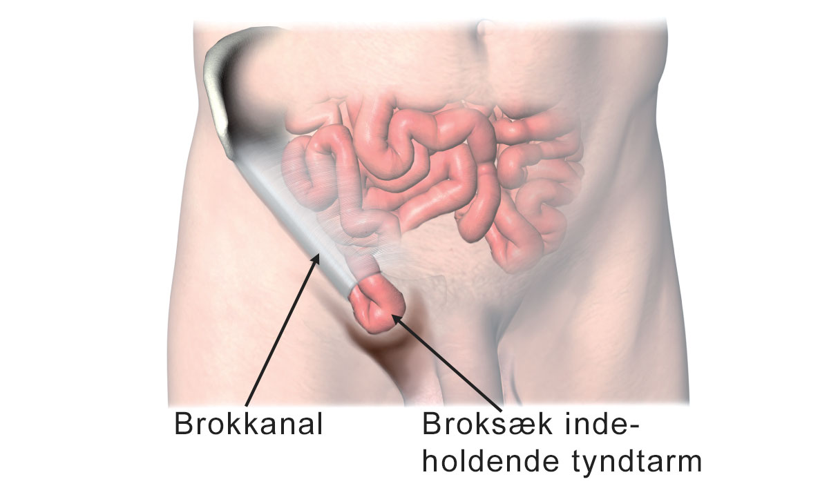Brokkanal og broksæd indeholdende tyndtarm.