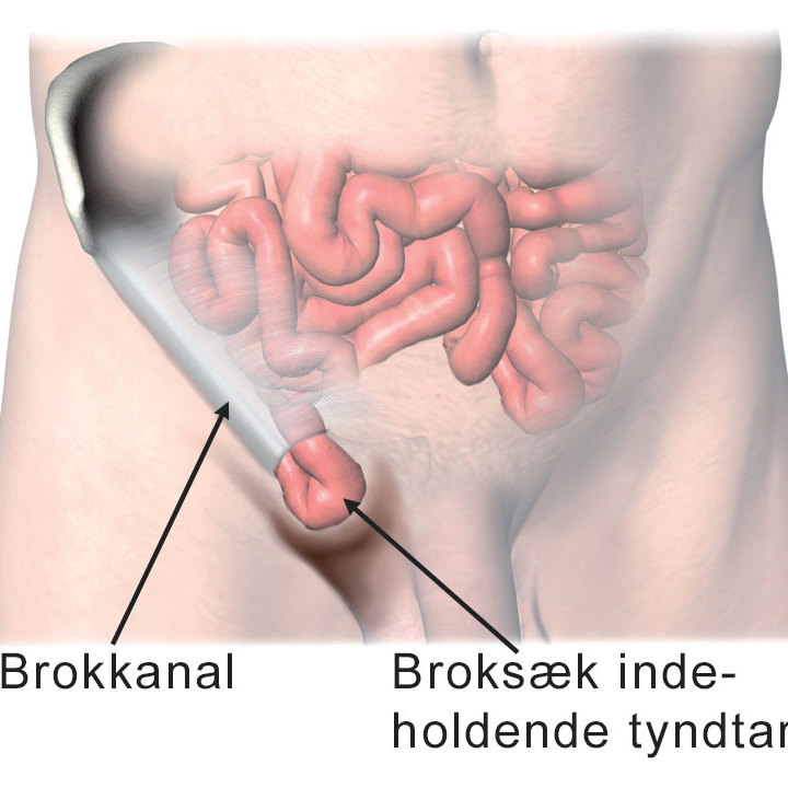 Brokkanal og broksæd indeholdende tyndtarm.