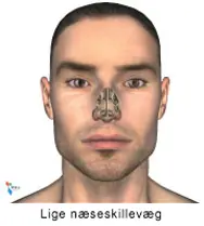 Illustration af en skæv næseskillevæg.