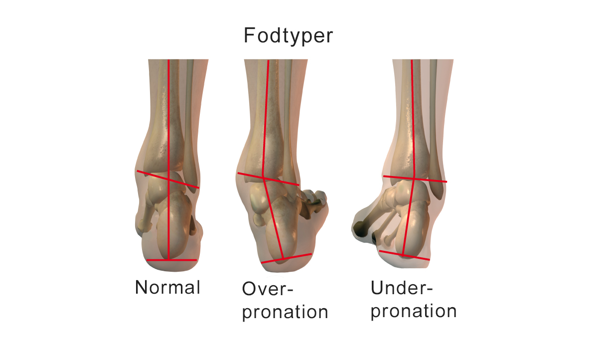 Illustration af ankelled set bagfra med forskellige pronationer.