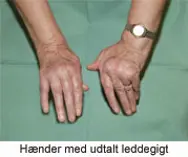 Hænder med udtalt leddegigt.