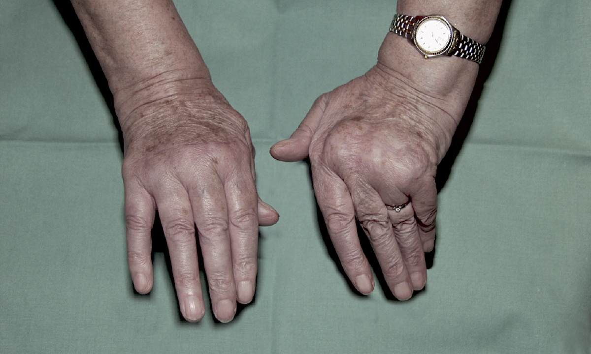 Billede af hænder med alvorlig leddegigt.