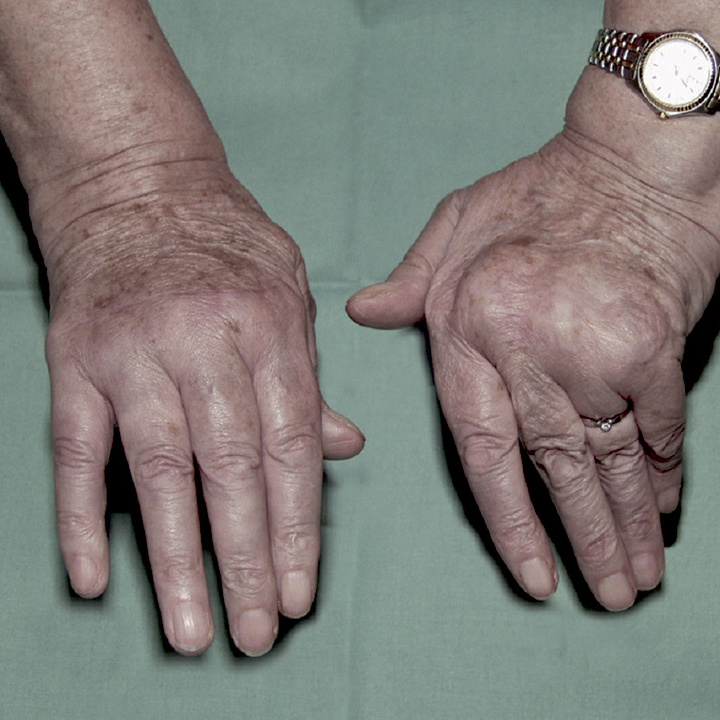 Billede af hænder med alvorlig leddegigt.