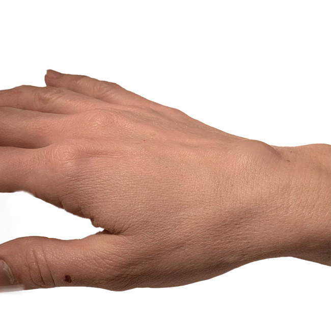 Billede af seneknude ved håndled.