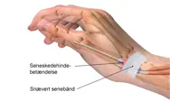 En hånd med seneskedehindebetændelse og snævert senebånd.