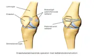 Illustration af knæskalsstabiliserende operation med ledbåndsrekonstruktion.