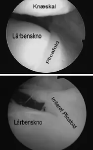 Slimhindefold irritation ved lårbensknoglen og knæskallen.
