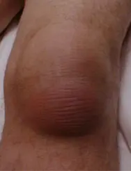 Billede af et knæ med slimsækbetændelse.