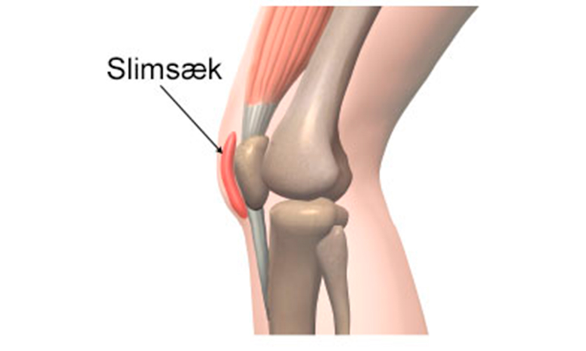 Illustration af slimsækbetændelse ved knæet.