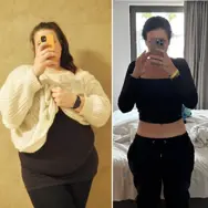 Ung kvinde viser, hvor meget hun har tabt sig efter overvægtsoperation hos Aleris.