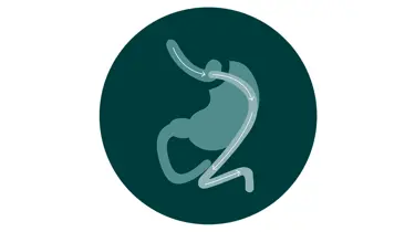 En lille illustration af en gastric bypass operation.