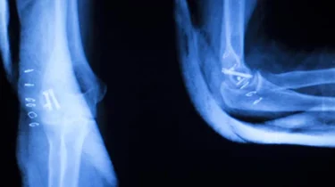 Røntgenbillede af en albue.