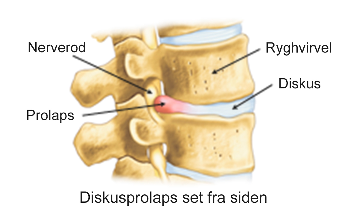 Illustration af diskusprolaps set fra siden.
