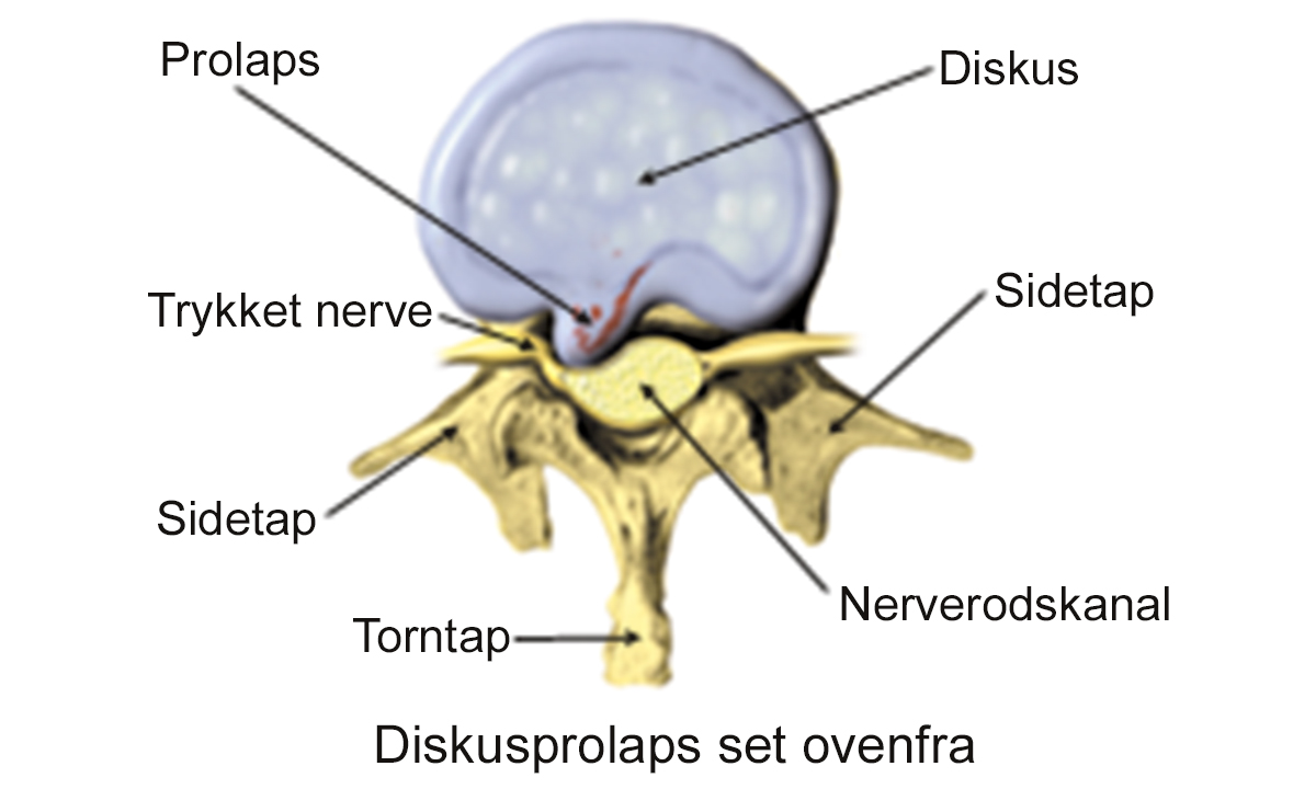 Illustration af diskusprolaps set ovenfra.