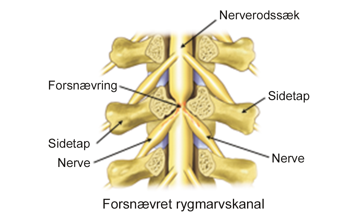 Illustration af spinalstenose i lænden.