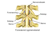 Illustration af spinalstenose i lænden.